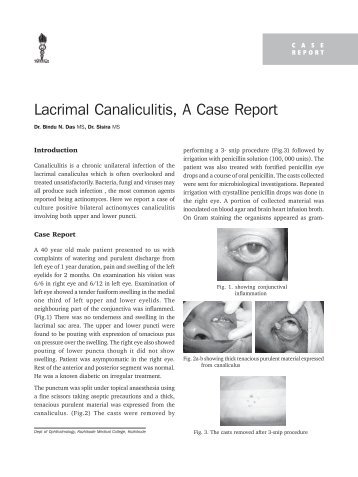 Lacrimal Canaliculitis, A Case Report - KSOS