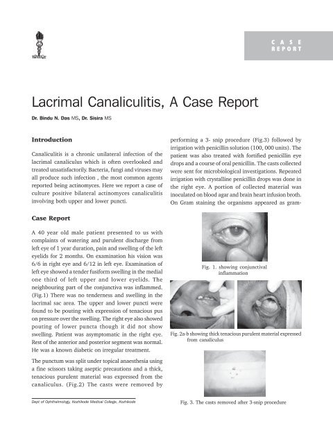 Lacrimal Canaliculitis, A Case Report - KSOS