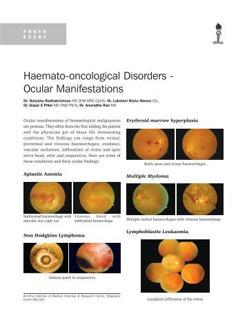 Haemato-oncological Disorders - Ocular Manifestations - KSOS