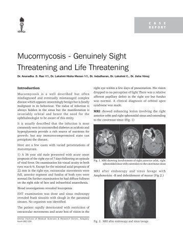 Mucormycosis - Genuinely Sight Threatening and Life ... - KSOS