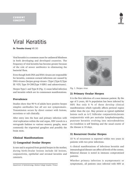 Viral Keratitis Ksos