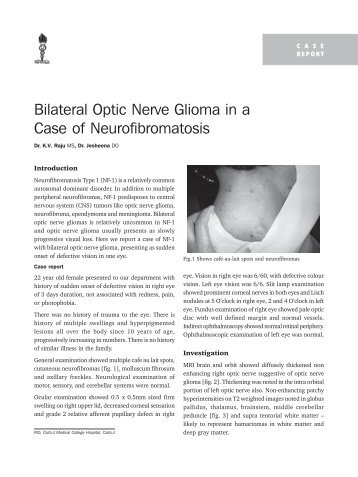 Bilateral Optic Nerve Glioma in a Case of Neurofibromatosis - KSOS