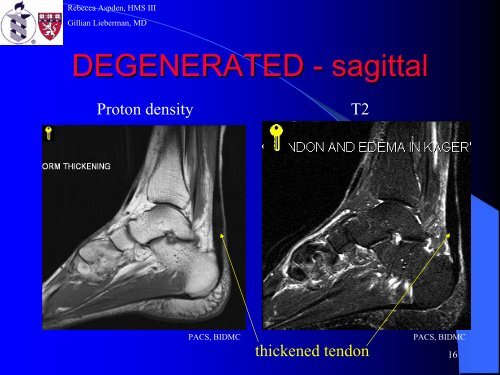 Achilles Tendon Rupture