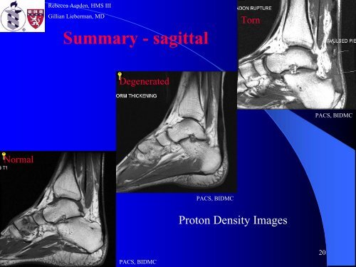 Achilles Tendon Rupture