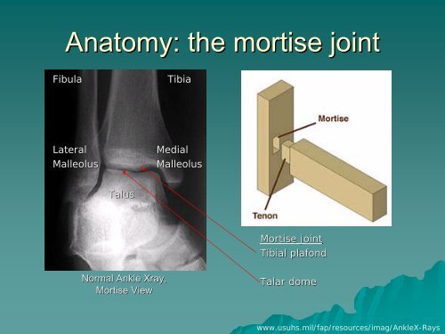 “Osteomyelitis of the Foot” - Lieberman's eRadiology Learning Sites