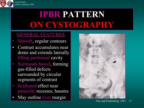 BLADDER RUPTURE