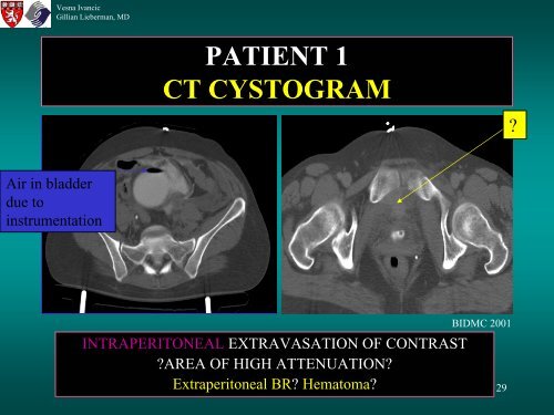 BLADDER RUPTURE