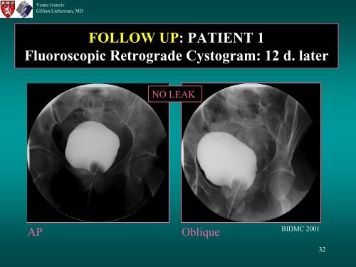 BLADDER RUPTURE