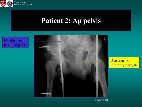 BLADDER RUPTURE