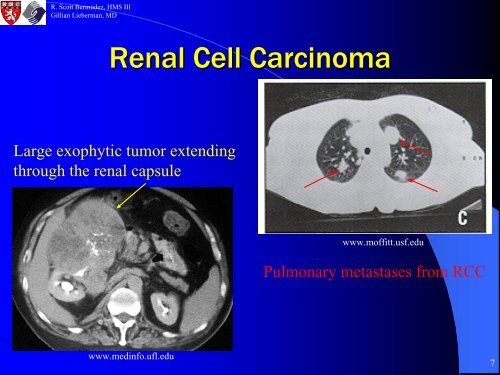 Percutaneous Radiofrequency Ablation