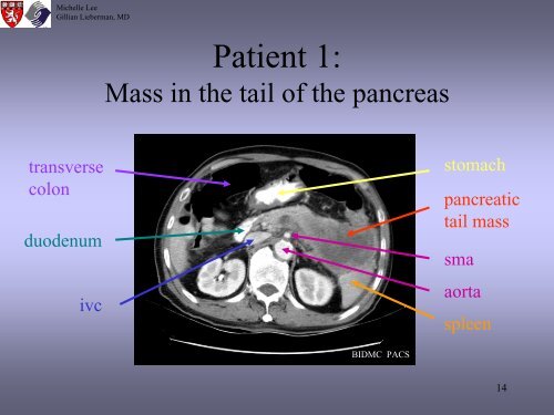 Radiologic Staging Of Pancreatic Cancer