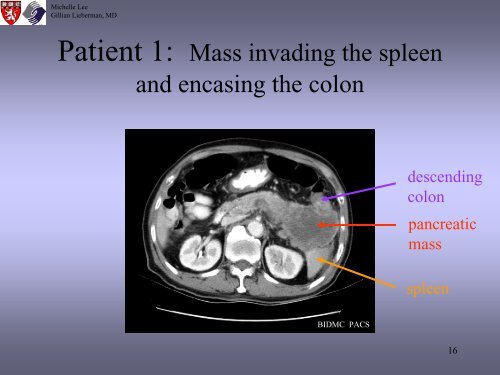 Radiologic Staging Of Pancreatic Cancer