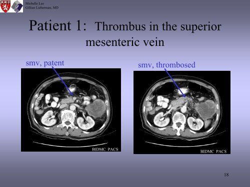 Radiologic Staging Of Pancreatic Cancer