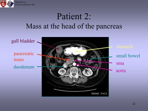 Radiologic Staging Of Pancreatic Cancer