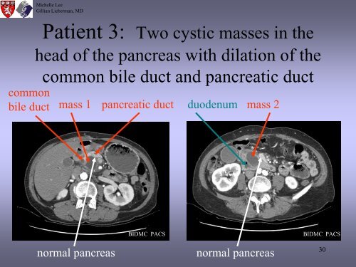 Radiologic Staging Of Pancreatic Cancer