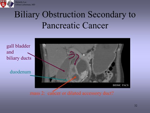 Radiologic Staging Of Pancreatic Cancer