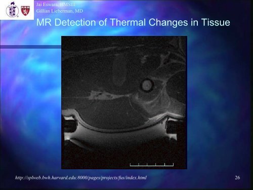 A52-Year-Old with Renal Mass / MR-Guided Focused Ultrasound