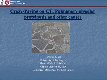 Crazy-Paving on CT: Pulmonary alveolar proteinosis and
