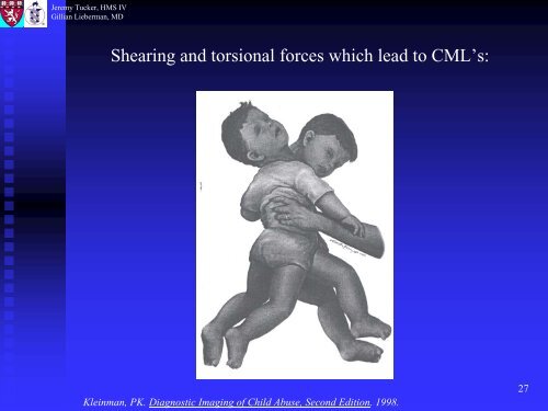 Metaphyseal and Rib Fractures in Child Abuse