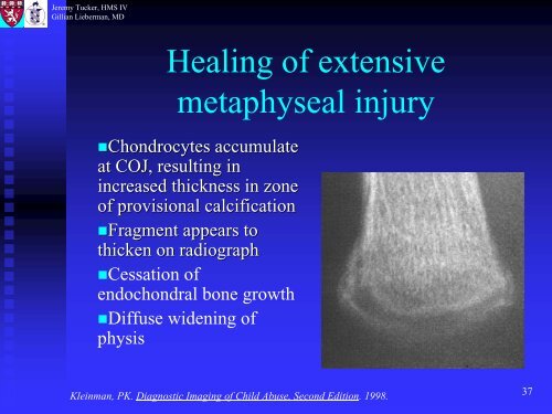 Metaphyseal and Rib Fractures in Child Abuse