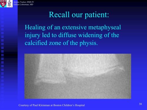 Metaphyseal and Rib Fractures in Child Abuse