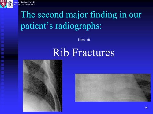 Metaphyseal and Rib Fractures in Child Abuse