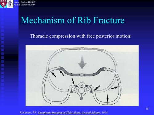 Metaphyseal and Rib Fractures in Child Abuse