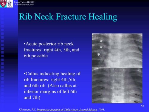 Metaphyseal and Rib Fractures in Child Abuse