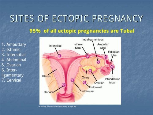 Sites Of Ectopic Pregnanc