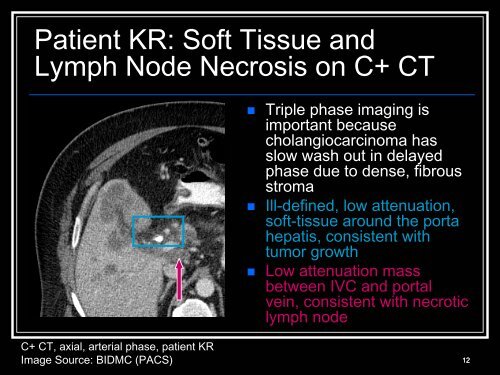 Klatskin tumors and other cholangiocarcinoma - Lieberman's ...