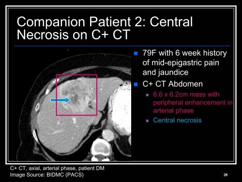 Klatskin tumors and other cholangiocarcinoma - Lieberman's ...