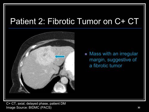 Klatskin tumors and other cholangiocarcinoma - Lieberman's ...