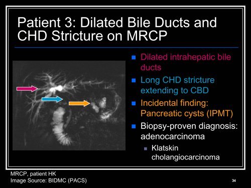 Klatskin tumors and other cholangiocarcinoma - Lieberman's ...