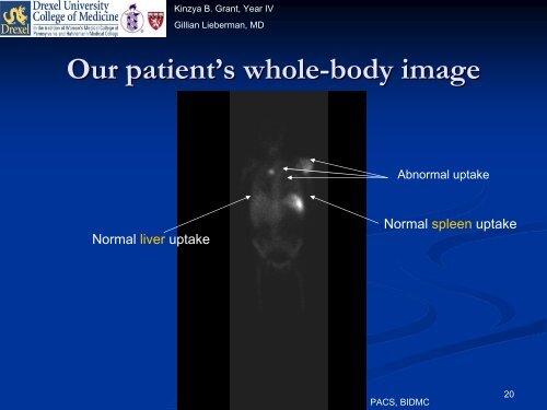 Indium-111 Leukocyte Scintigraphy - Lieberman's eRadiology ...