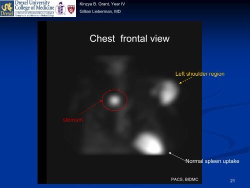 Indium-111 Leukocyte Scintigraphy - Lieberman's eRadiology ...