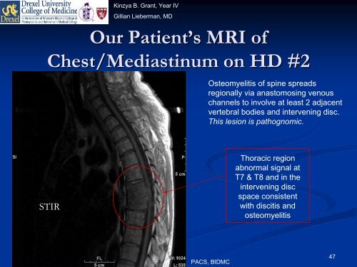 Indium-111 Leukocyte Scintigraphy - Lieberman's eRadiology ...