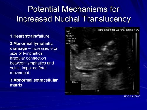 Nuchal Translucency in First-Trimester Ultrasound Screening for ...