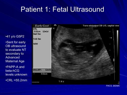 Nuchal Translucency in First-Trimester Ultrasound Screening for ...