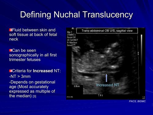 Nuchal Translucency in First-Trimester Ultrasound Screening for ...