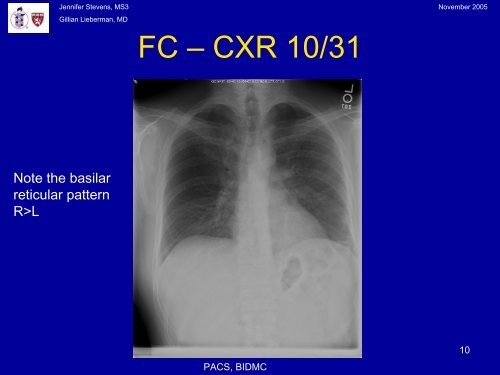 Pneumocystis Pneumonia: The radiology of an AIDS- defining illness