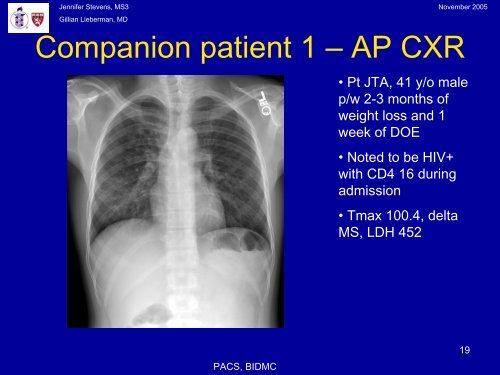 Pneumocystis Pneumonia: The radiology of an AIDS- defining illness