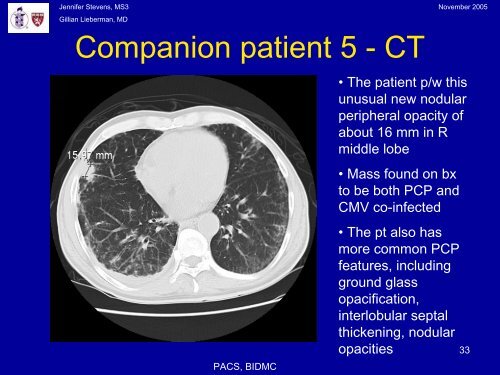 Pneumocystis Pneumonia: The radiology of an AIDS- defining illness