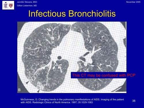 Pneumocystis Pneumonia: The radiology of an AIDS- defining illness