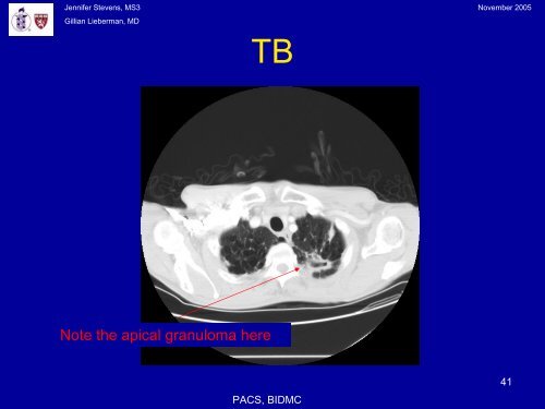 Pneumocystis Pneumonia: The radiology of an AIDS- defining illness