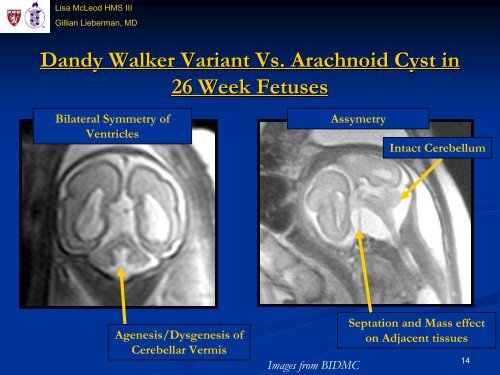 Use of MRI in Evaluating Fetal Ventriculomegaly