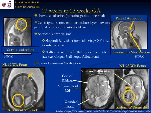 Use of MRI in Evaluating Fetal Ventriculomegaly