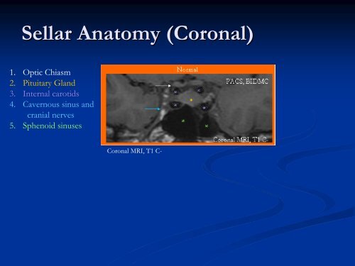 Imaging The Turkish Saddle - Lieberman's eRadiology Learning Sites