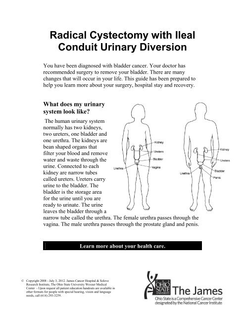 Radical Cystectomy With Ileal Conduit Urinary Diversion - 