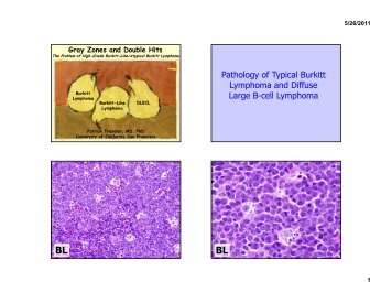 The Problem of High-Grade Burkitt-Like/Atypical Burkitt Lymphoma