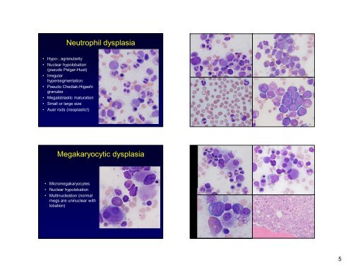 Myelodysplastic Syndromes